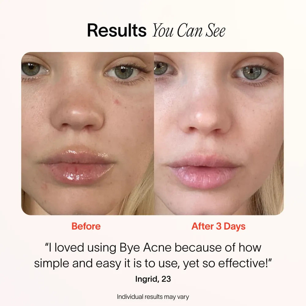 Bye Acne 3 Minute Pimple Spot Treatment Womens Health Shop 7106